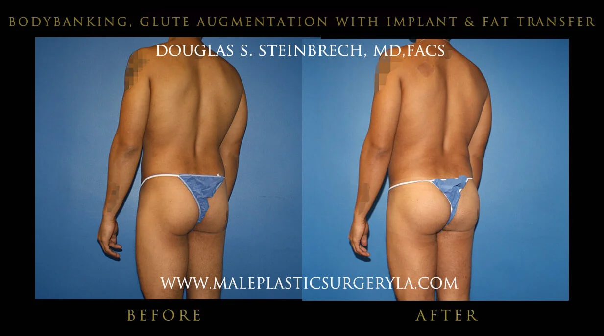 Liposuction - Before & After Photos