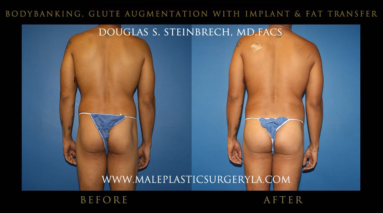 Liposuction - Before & After Photos