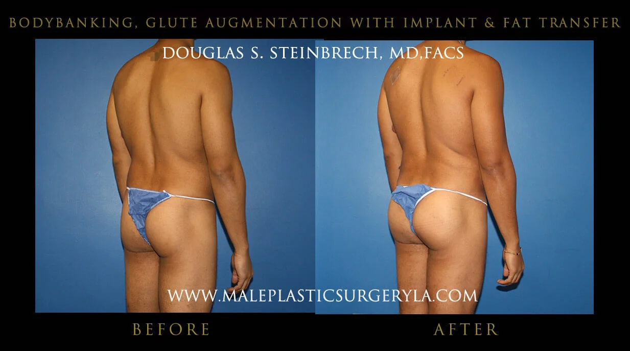 Liposuction - Before & After Photos