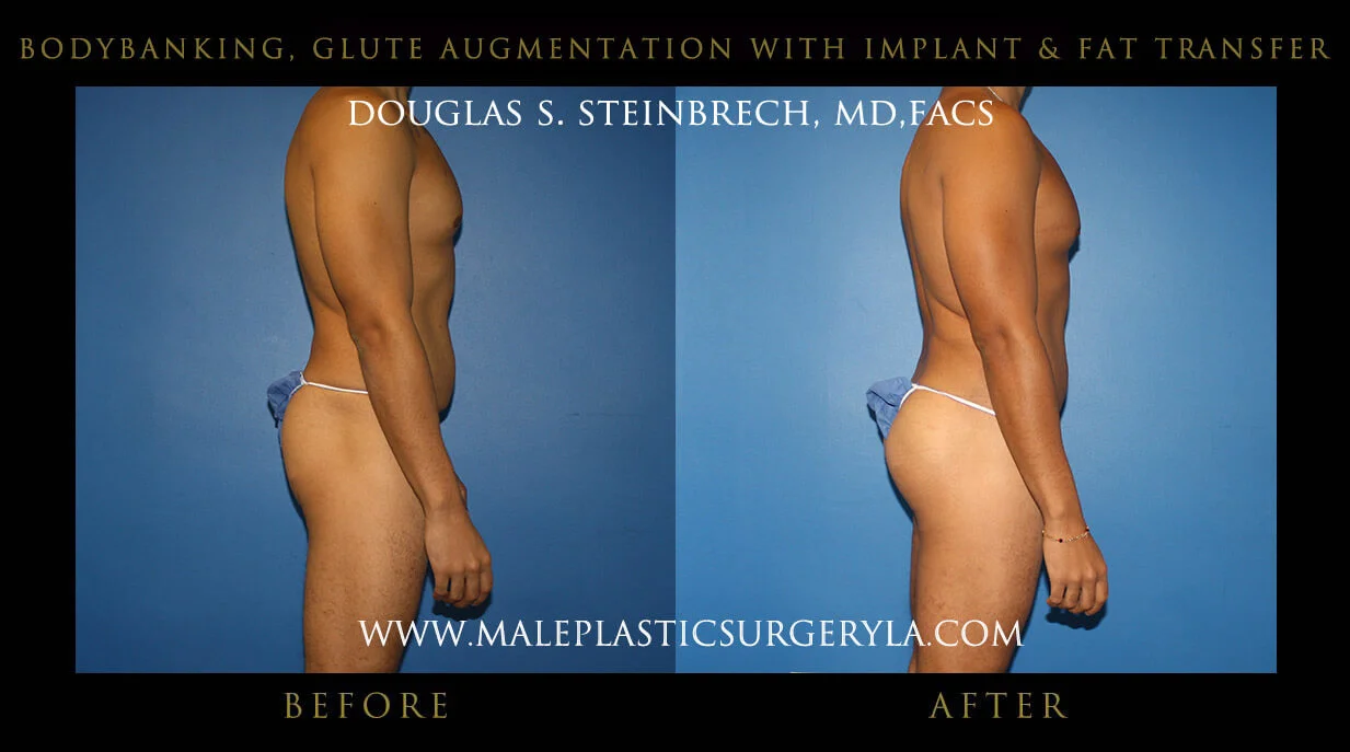 Liposuction - Before & After Photos