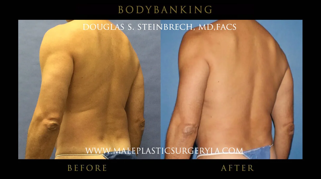 Liposuction - Before & After Photos