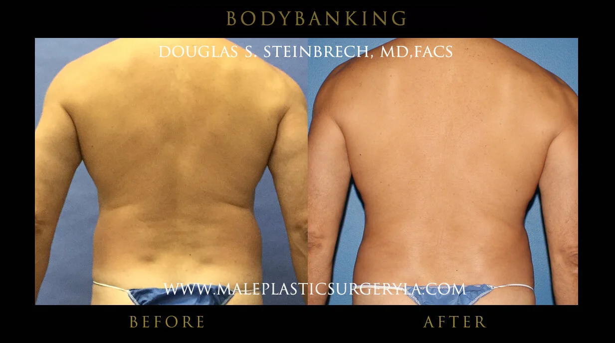 Liposuction - Before & After Photos