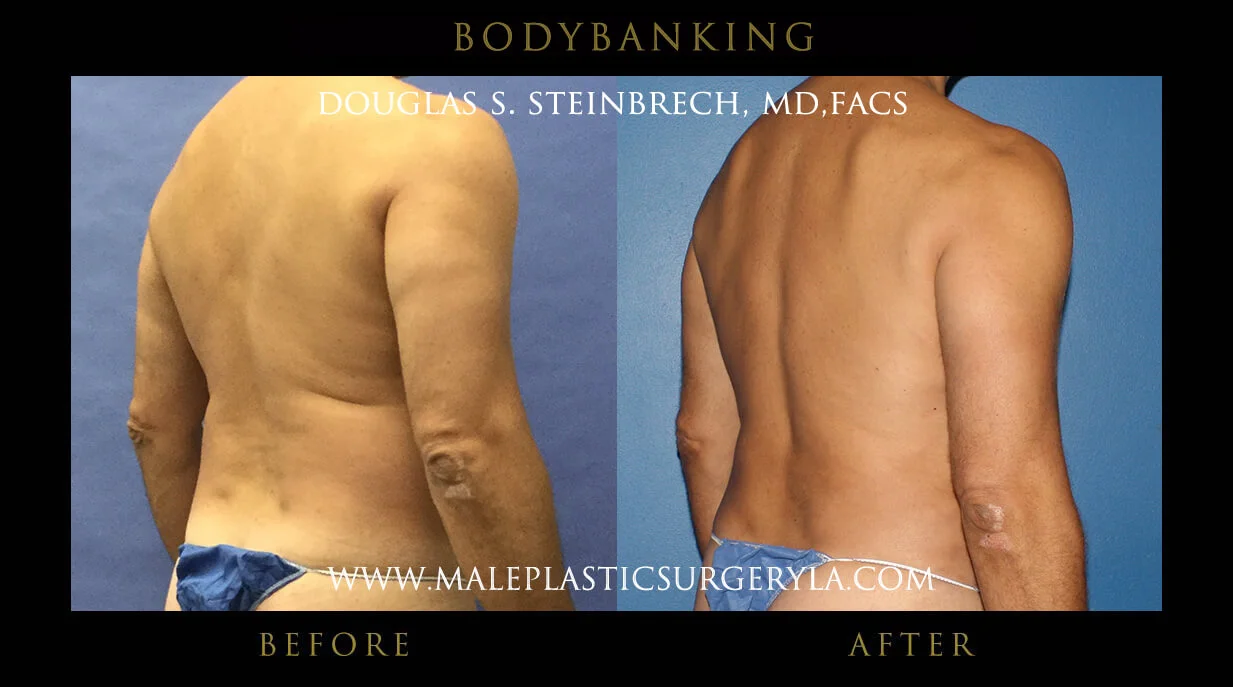 Liposuction - Before & After Photos