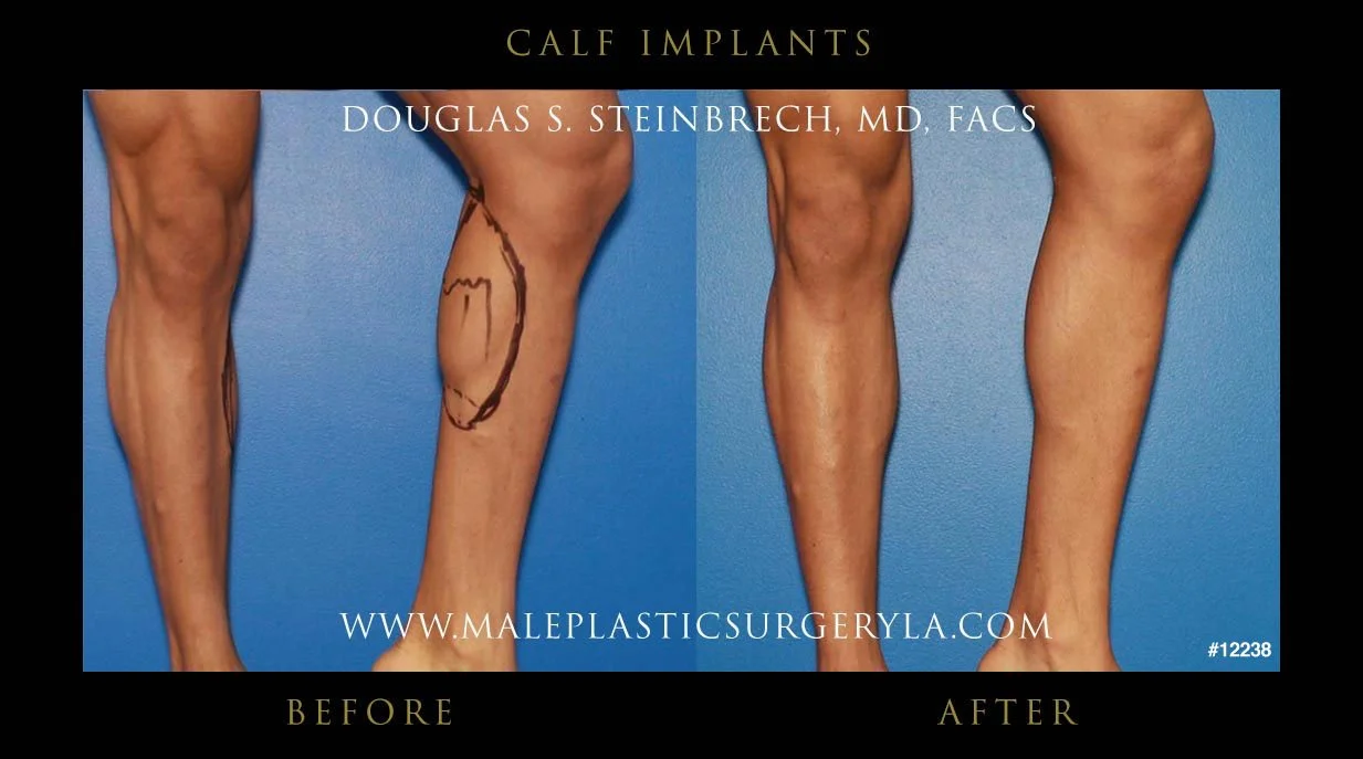 Calf Implants Before and After Photos