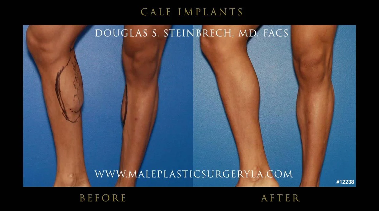 Calf Implants Before and After Photos