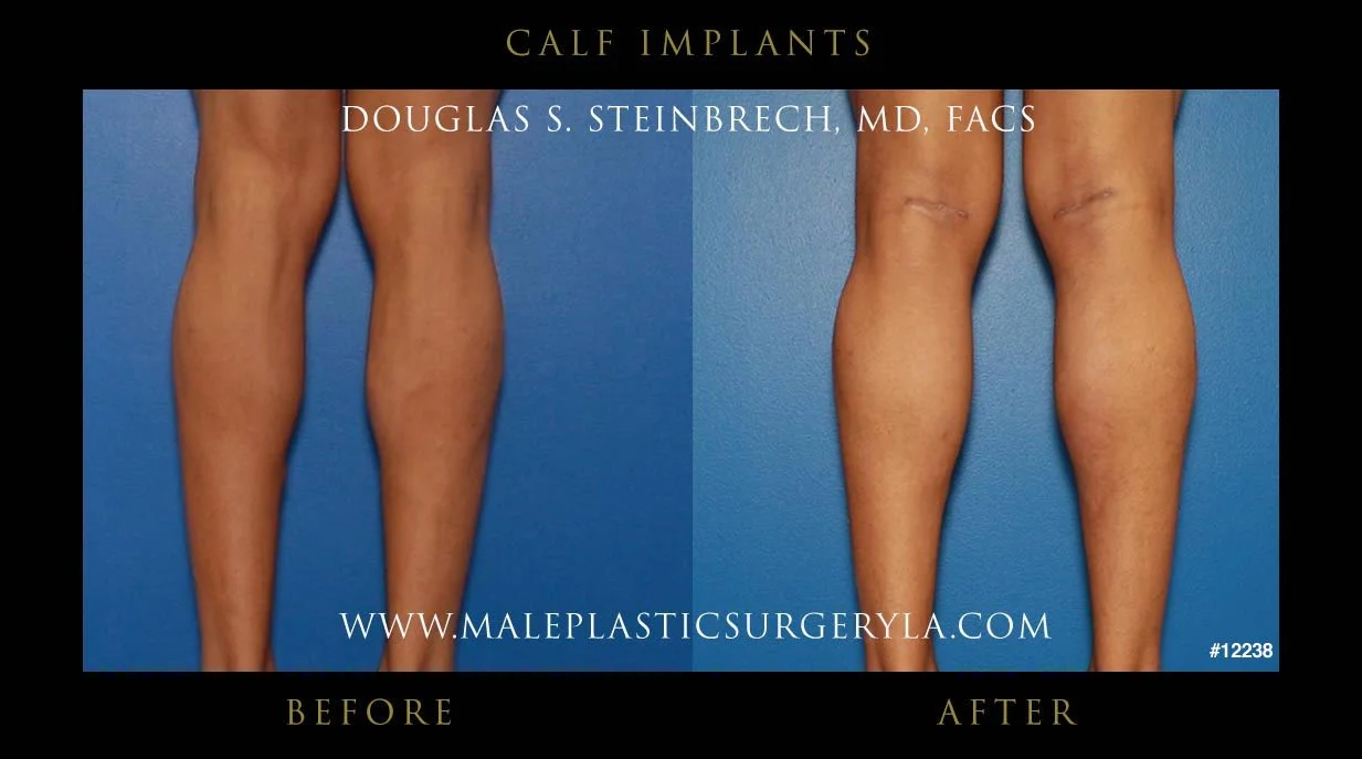 Calf Implants Before and After Photos