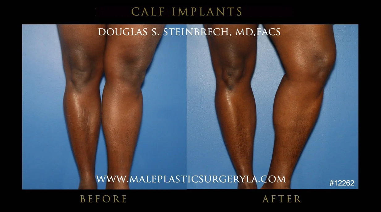 Calf Implants Before and After Photos