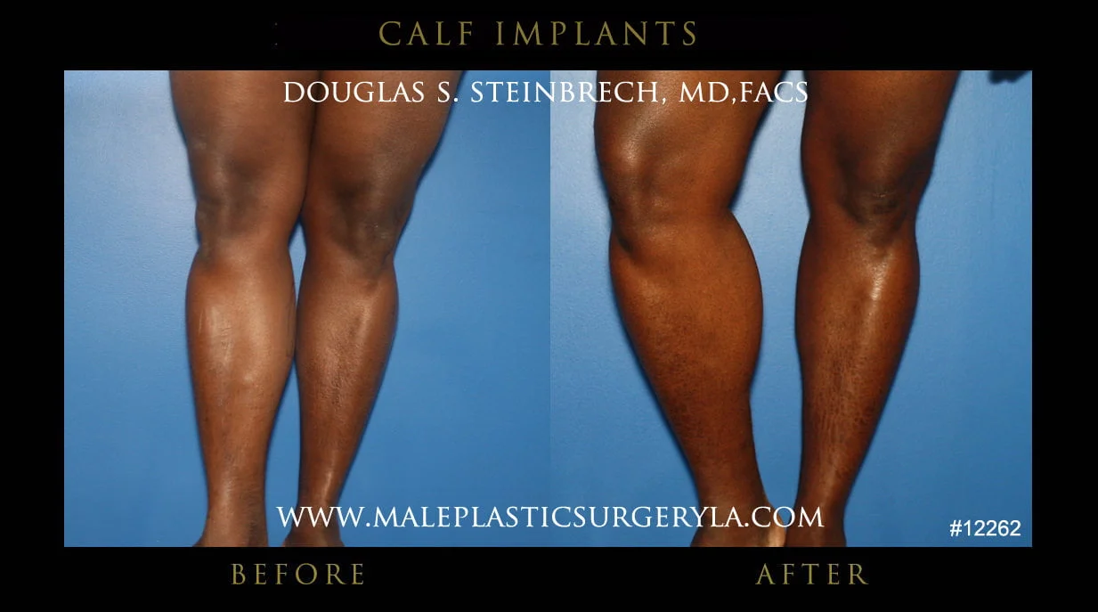 Calf Implants Before and After Photos