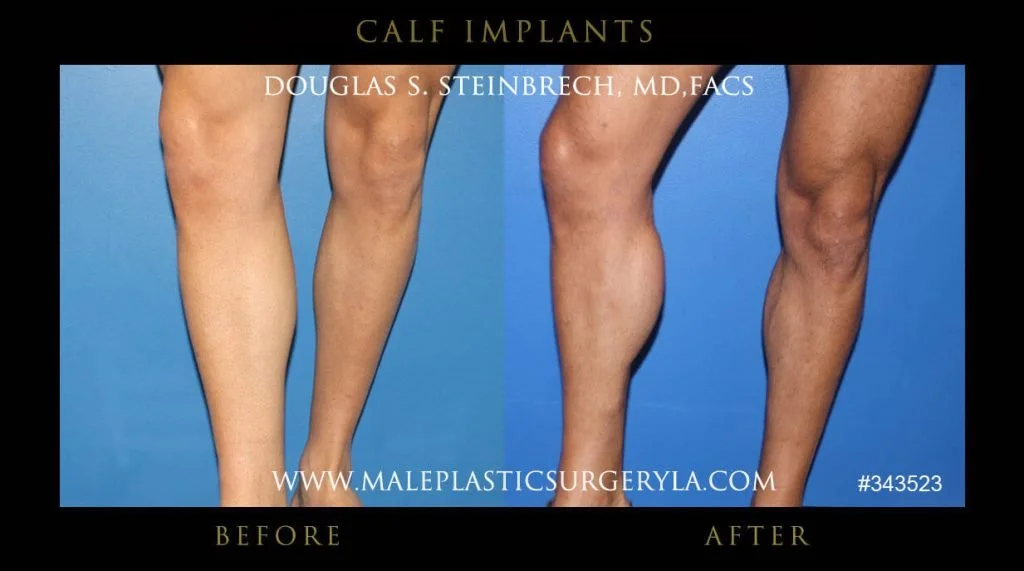 Calf Implants Before and After Photos