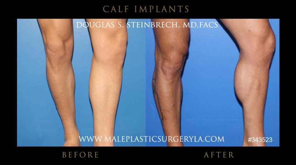 Calf Implants Before and After Photos