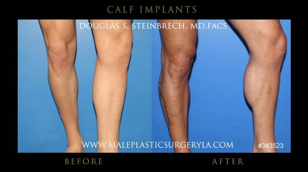 Calf Implants Before and After Photos