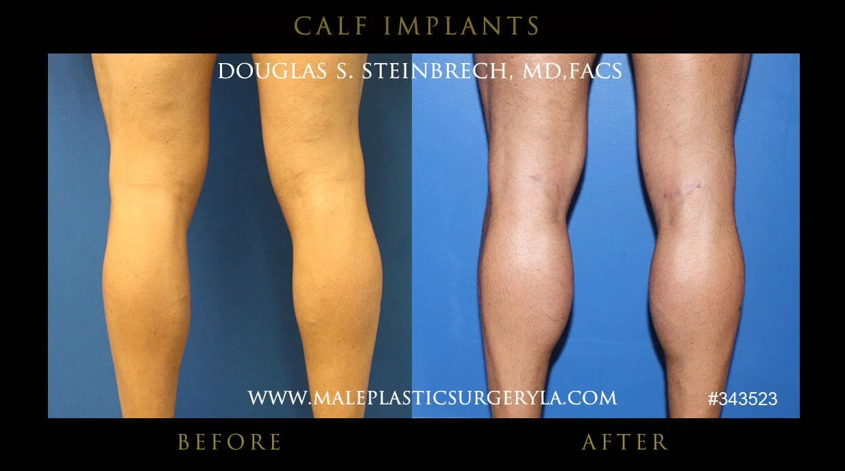 Calf Implants Before and After Photos