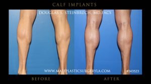 calf implants 2