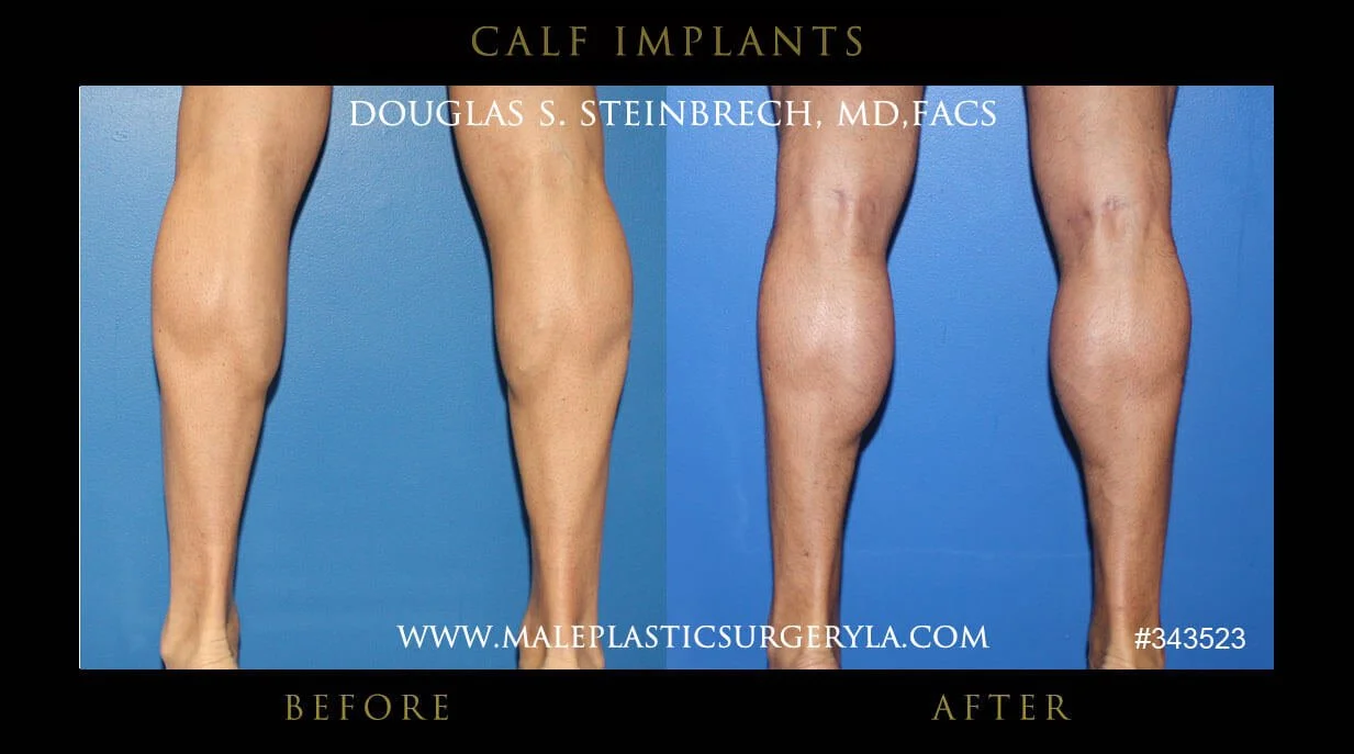 Calf Implants Before and After Photos