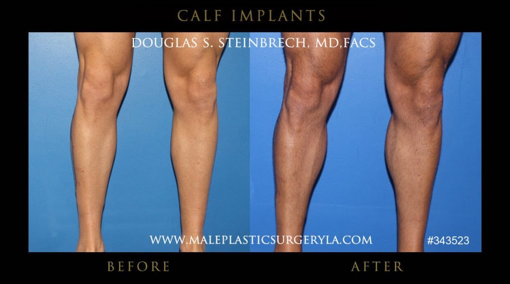 Calf Implants Before and After Photos