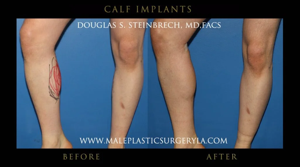 Calf Implants Before and After Photos