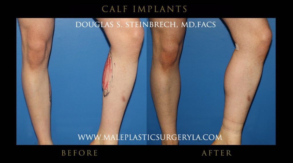 Calf Implants Before and After Photos