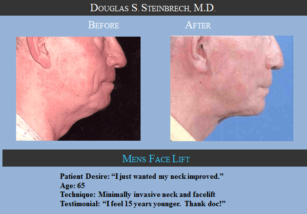 facelift-Before-After-photo-Los-Angeles-CA