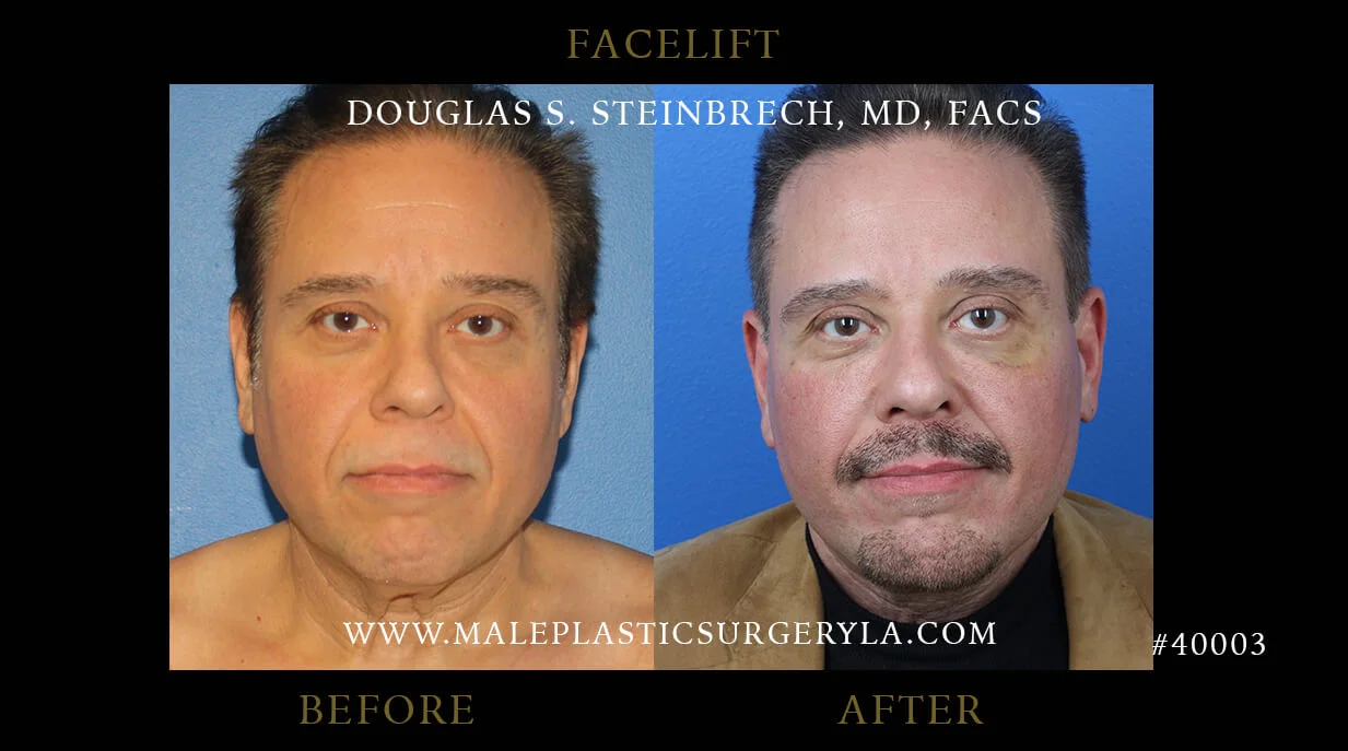 Male Face Gallery - Before & After Photos