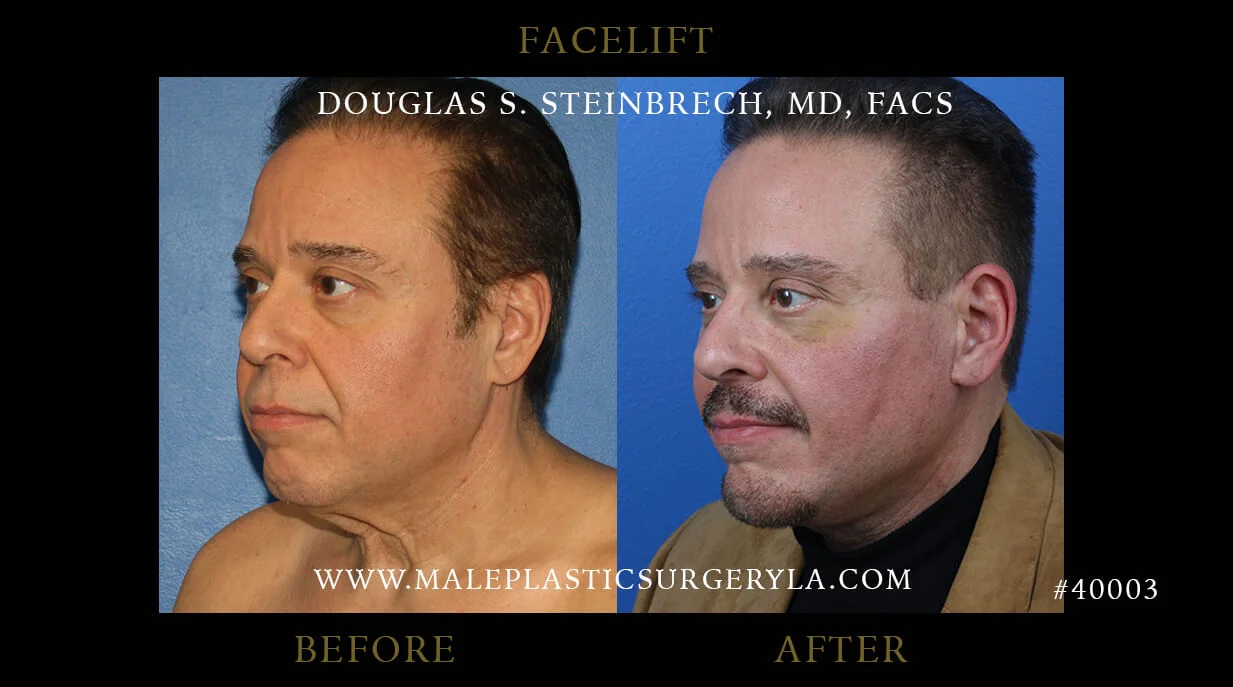 Male Face Gallery - Before & After Photos