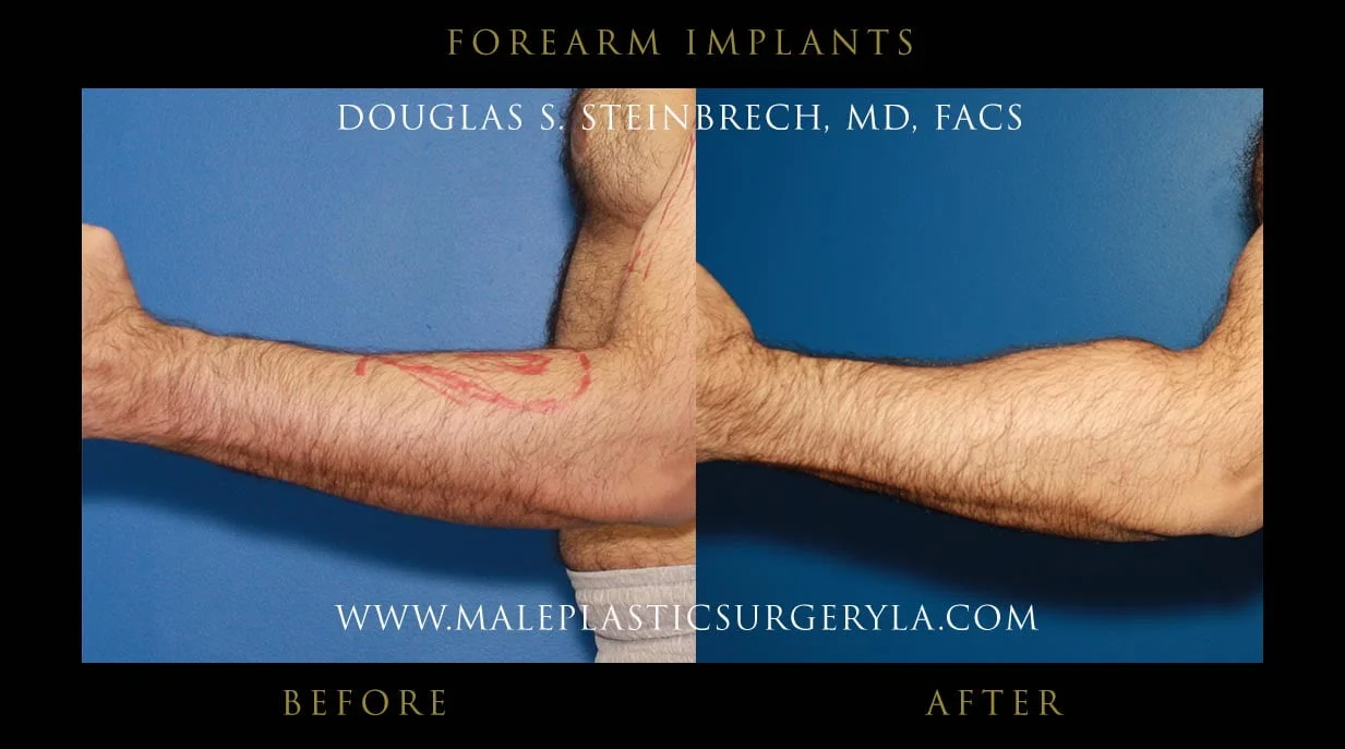 Forearm Implants - Before & After Photos