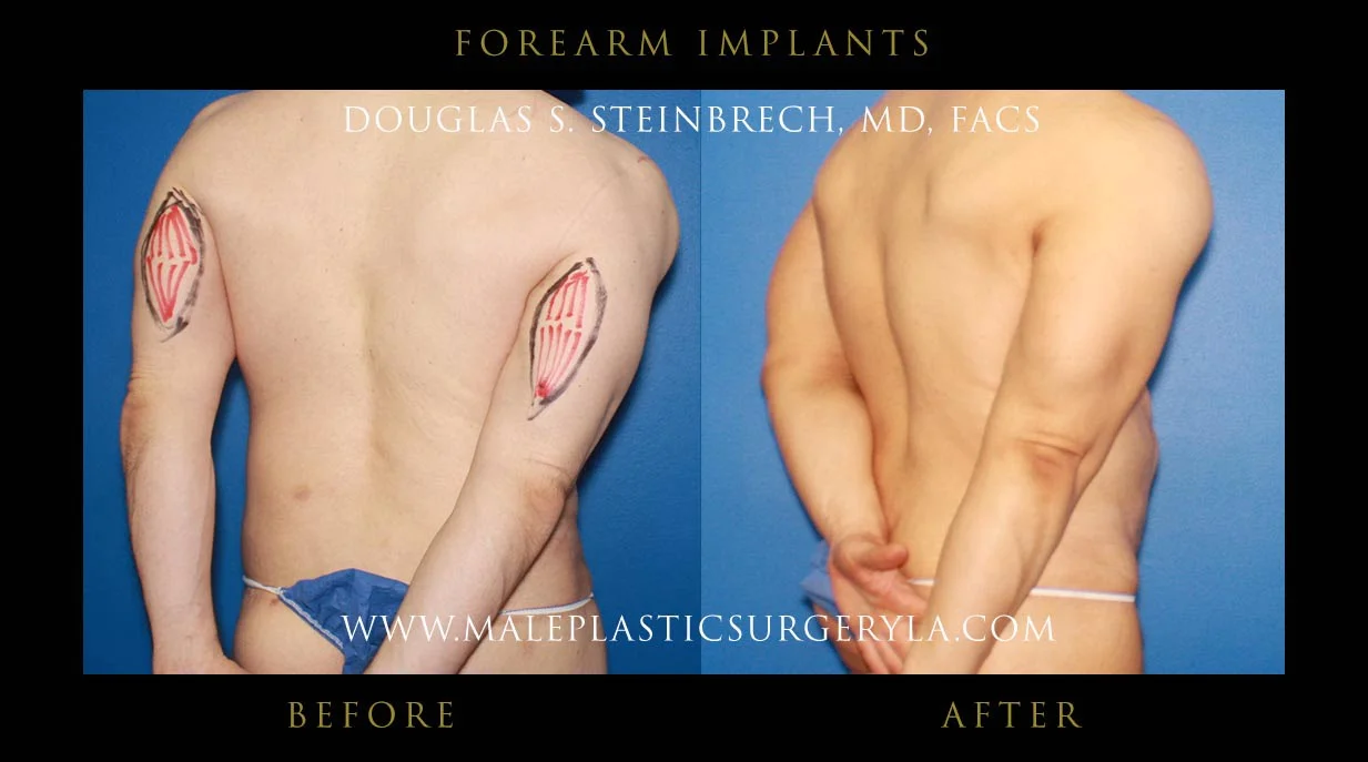 Forearm Implants - Before & After Photos