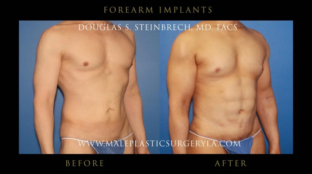 Forearm Implants - Before & After Photos