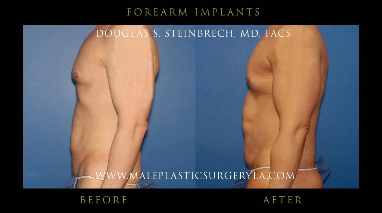 Forearm Implants - Before & After Photos