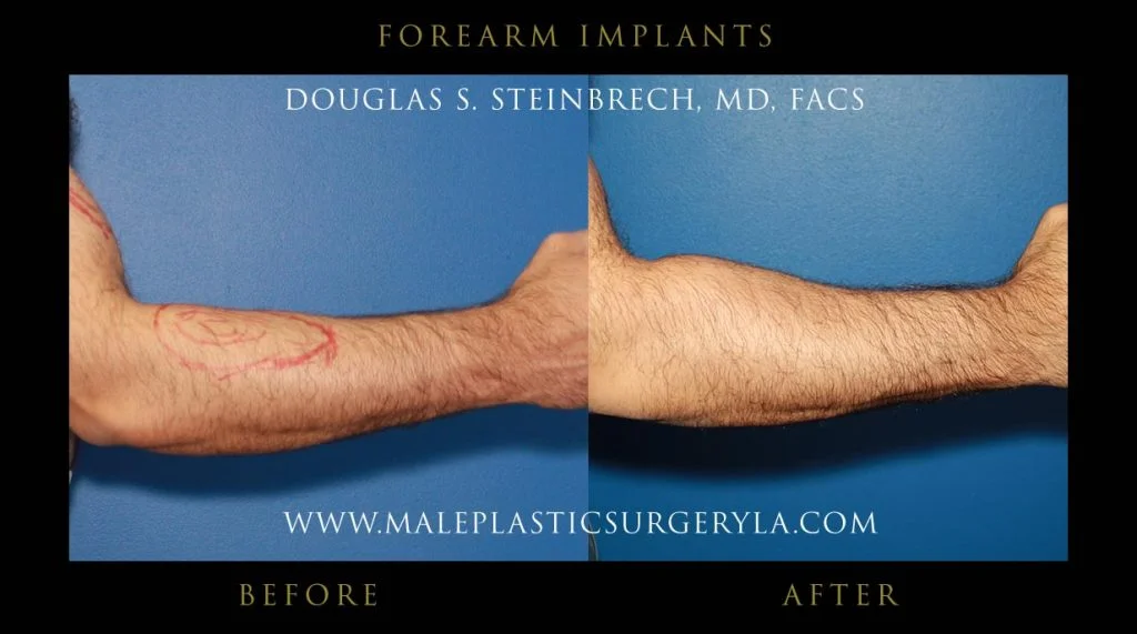 Forearm Implants - Before & After Photos