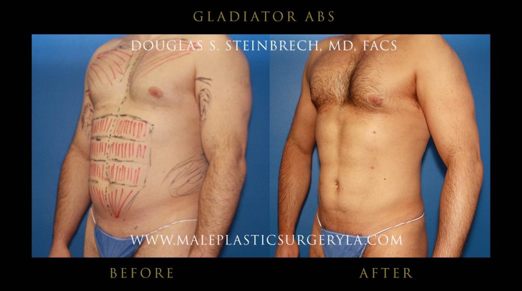 Gladiator Abs - Before & After Photos