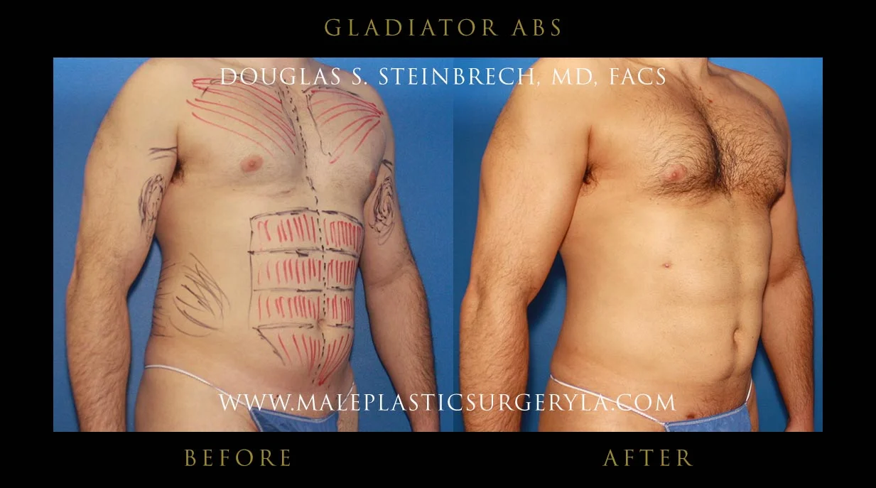 Gladiator Abs - Before & After Photos