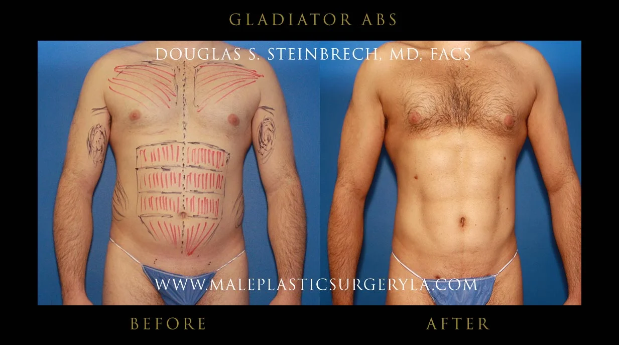 Gladiator Abs - Before & After Photos