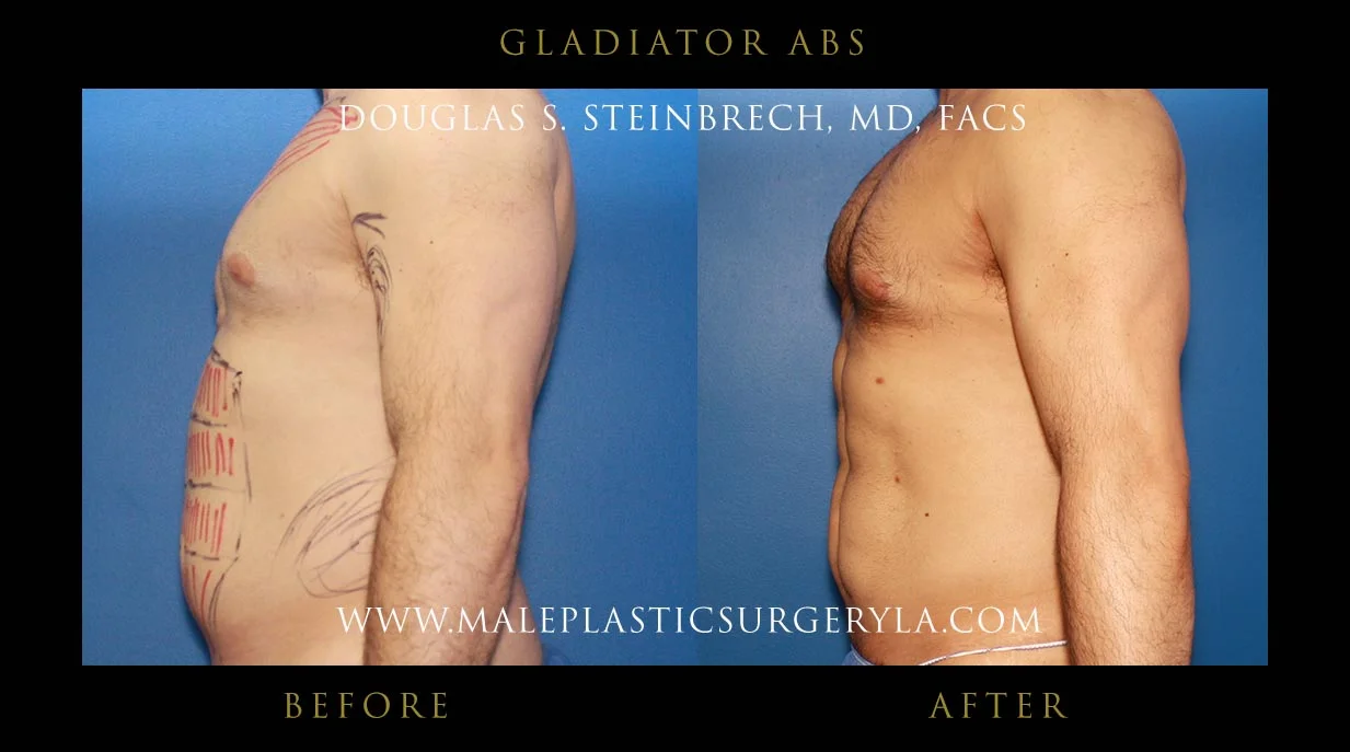 Gladiator Abs - Before & After Photos