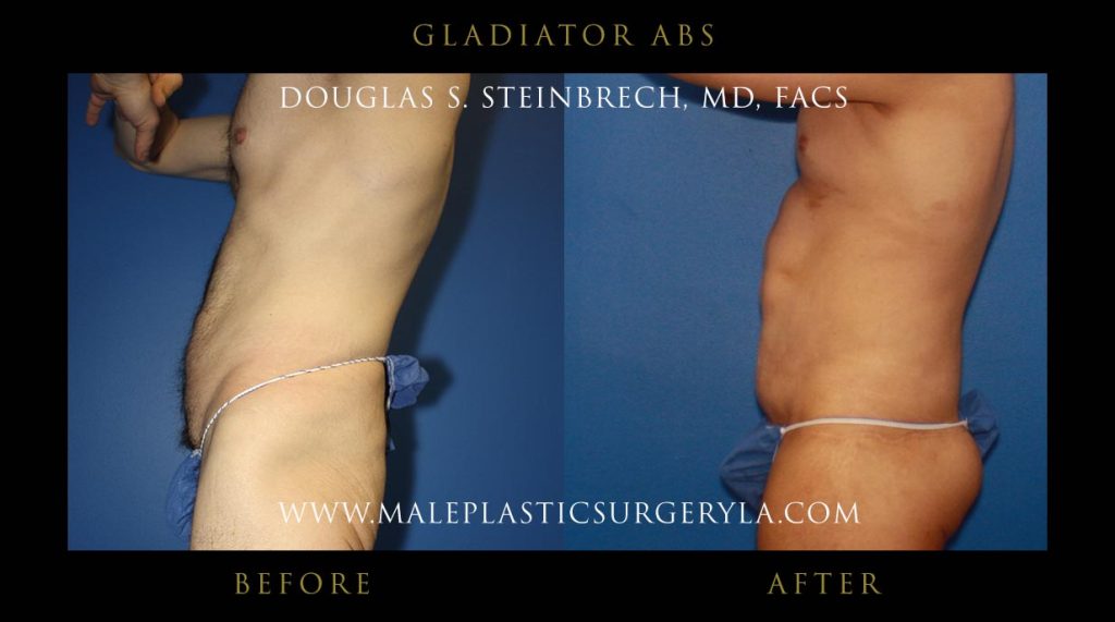 Gladiator Abs - Before & After Photos