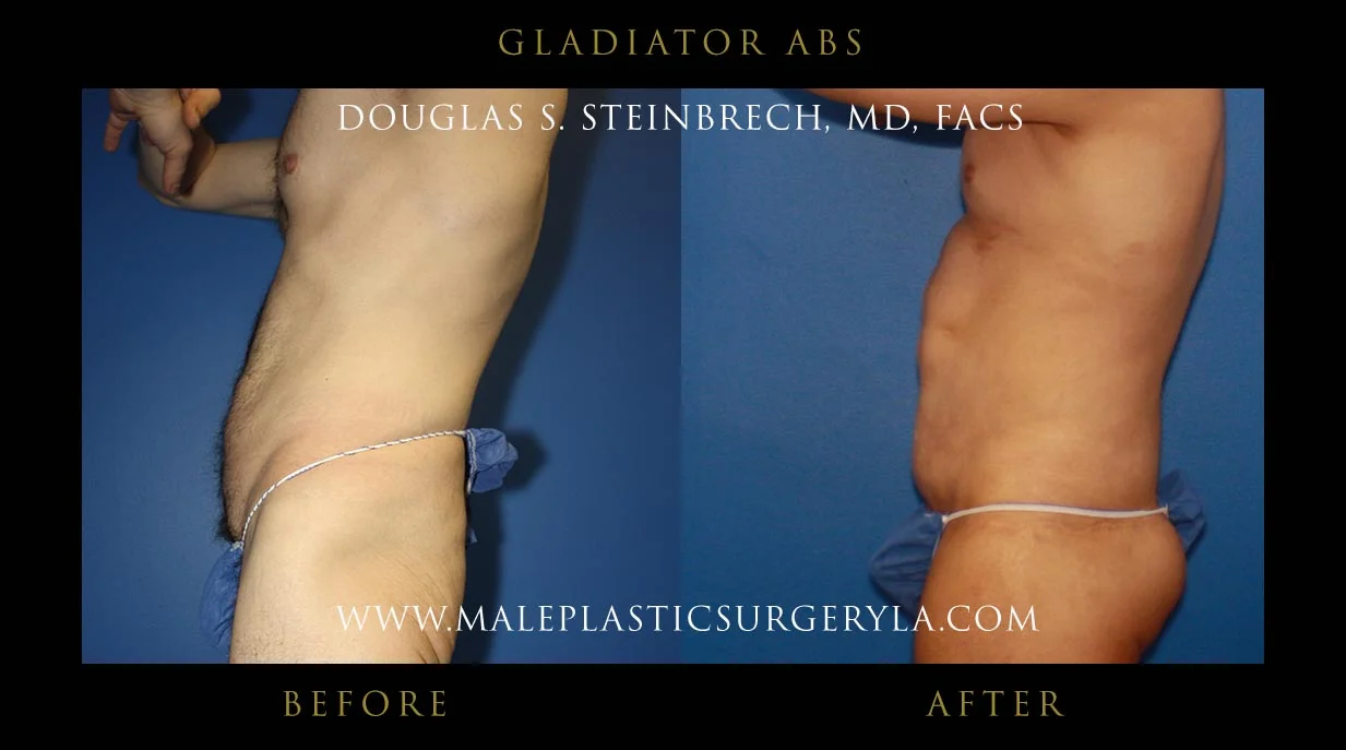 Gladiator Abs - Before & After Photos