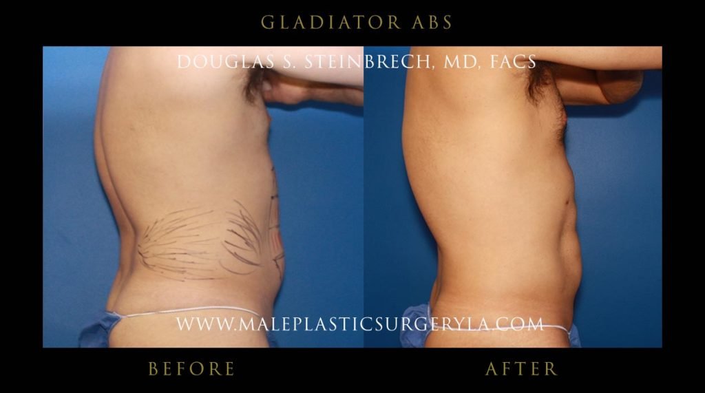 Gladiator Abs - Before & After Photos