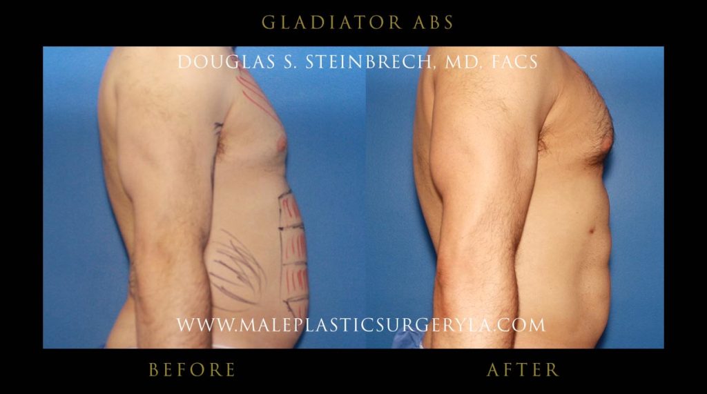 Gladiator Abs - Before & After Photos