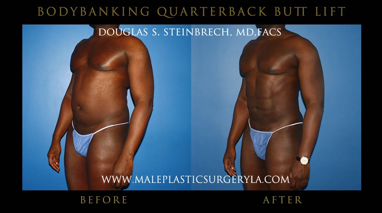 Liposuction - Before & After Photos