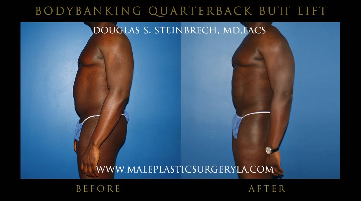 Liposuction - Before & After Photos