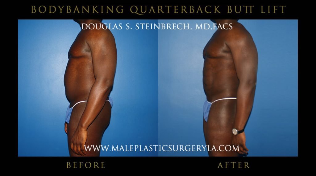 Gladiator Abs - Before & After Photos