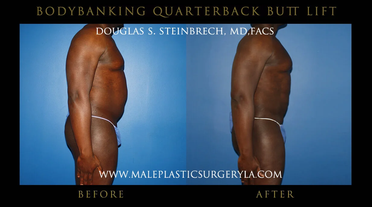 Liposuction - Before & After Photos