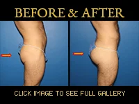 Gluteal Implants - Before & After Photo