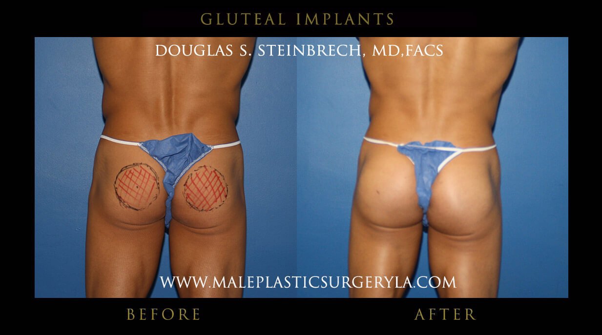 gluteal augmentation: the ultimate way to achieve your body butt goals in shape