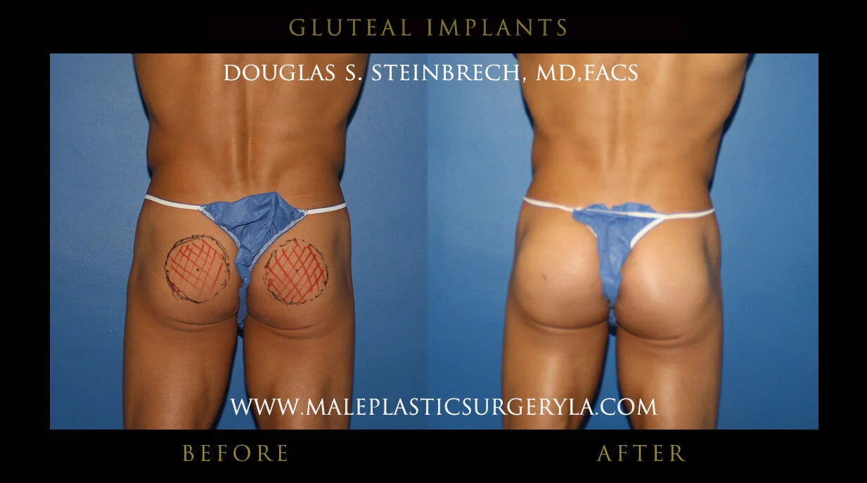 gluteal augmentation: the ultimate way to achieve your body butt goals in shape