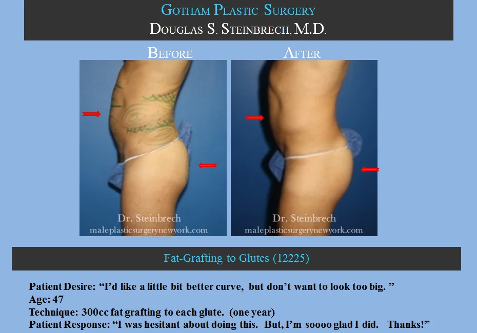 Fat Grafting - Before & After Photos