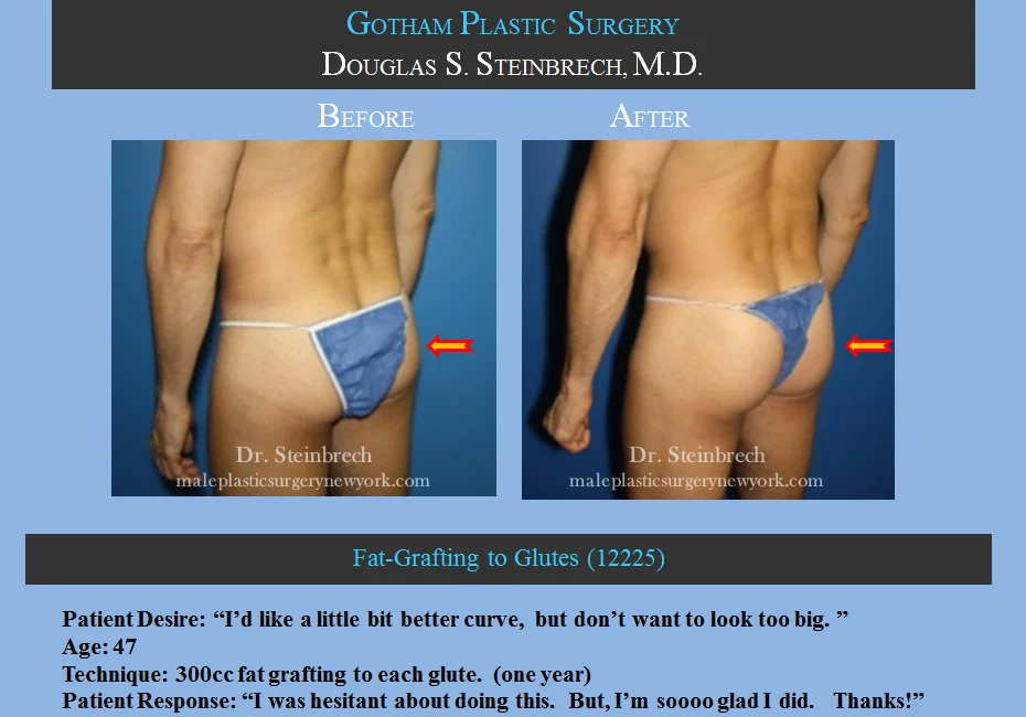 Fat Grafting - Before & After Photos