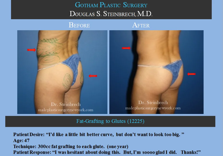 Fat Grafting - Before & After Photos