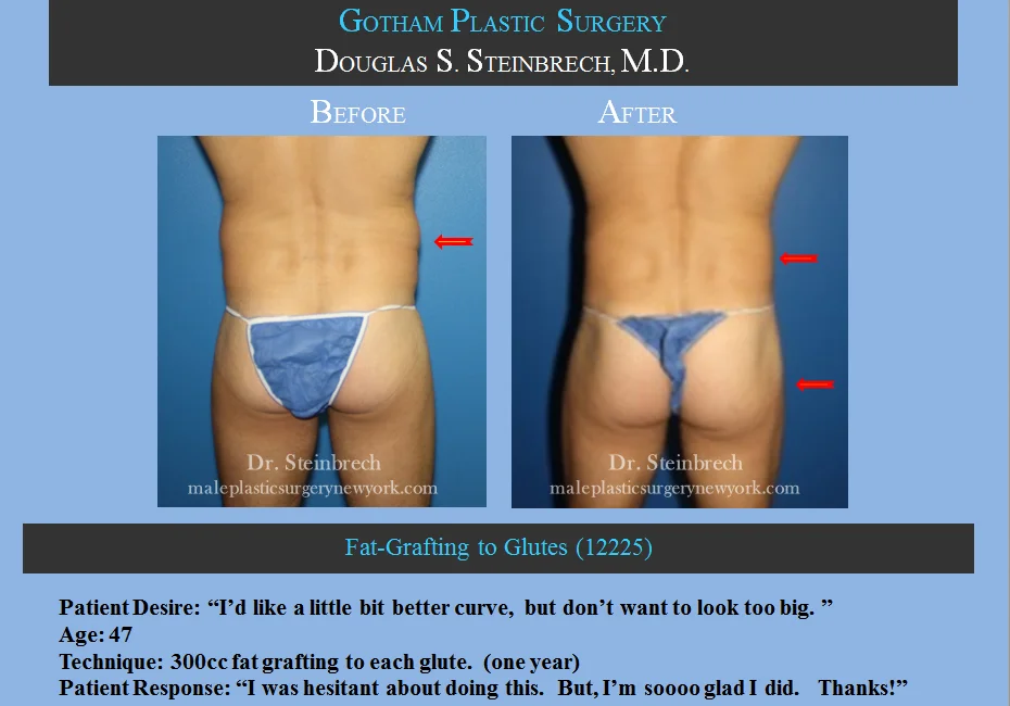 Fat Grafting - Before & After Photos