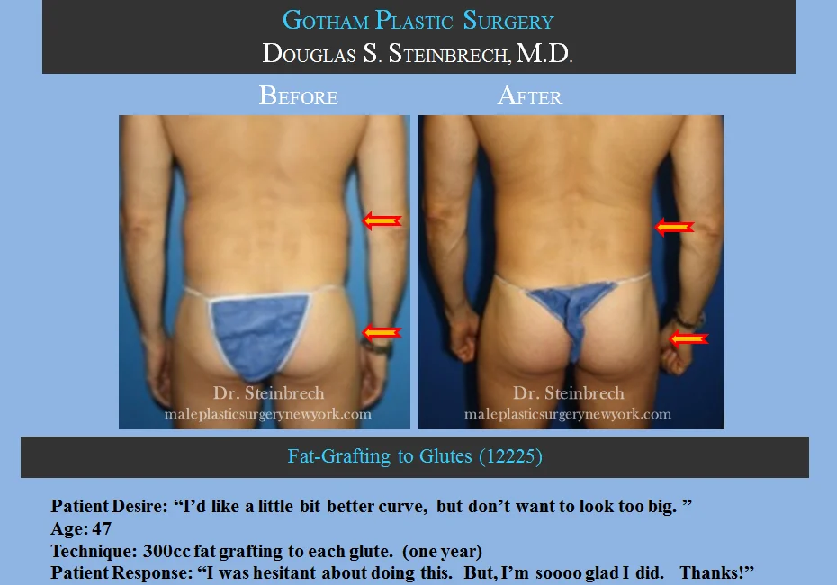 Fat Grafting - Before & After Photos