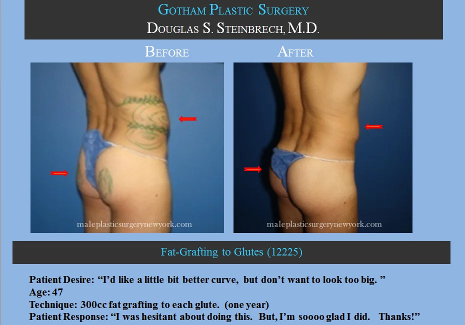 Fat Grafting - Before & After Photos